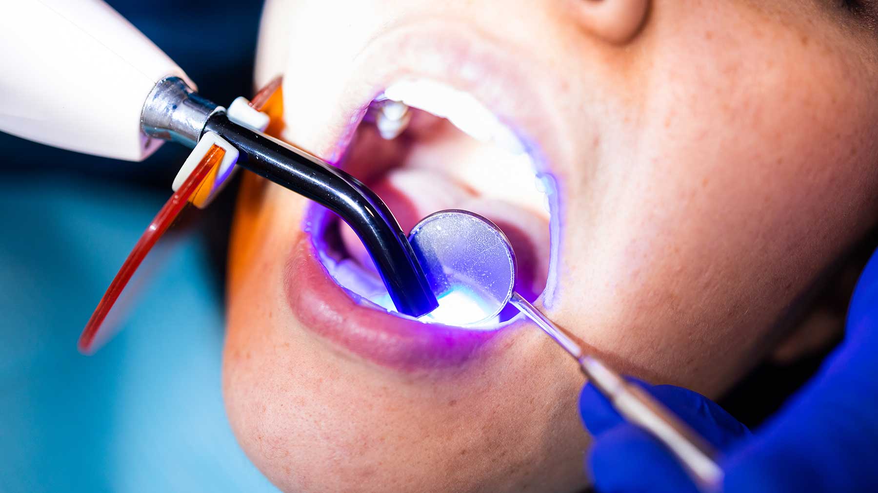 Restoration / Filling